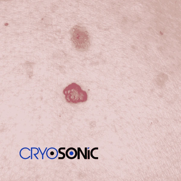 Looking for pain free cherry angioma removal treatment Tavistock? Call our team today! Tavistock