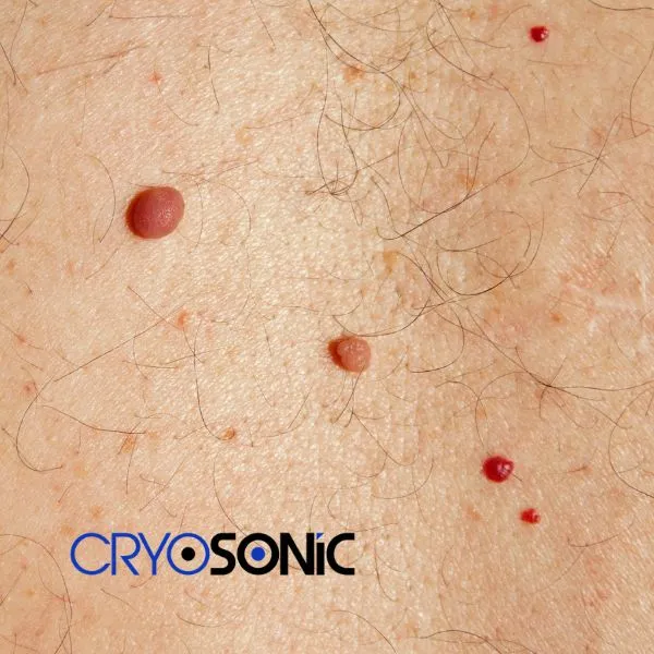 get cherry angioma removal treatment today! Tavistock