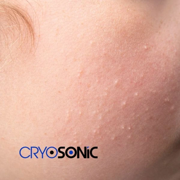 Are you looking for milia removal treatment? Contact our team today Tavistock