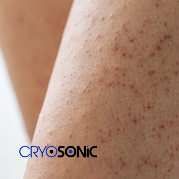 Looking for Seborrhoeic Keratosis removal Tavistock treatment? Call our consultants today in Tavistock
