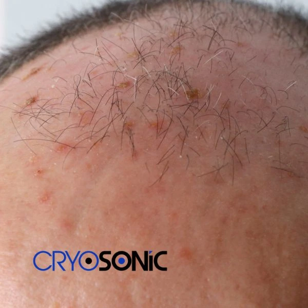 Access Seborrhoeic Keratosis removal from the comfort of your own home! Call us today in Tavistock