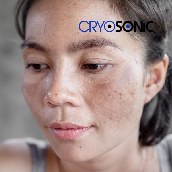 Ready to start age spots removal? Contact our team today in Tavistock