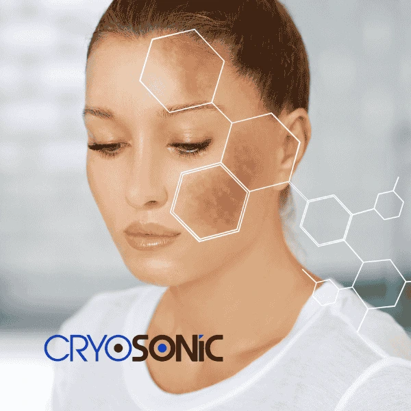 Are you looking for age spot removal treatment? Contact Cryosonic today in Tavistock
