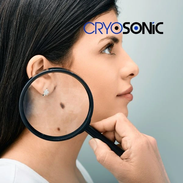 Do you want to learn more about benign moles removal treatment? Call our team today Tavistock