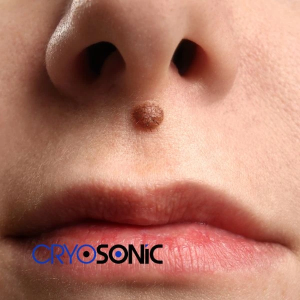 Start your benign moles removal treatment today Tavistock