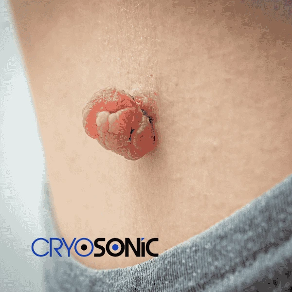 Book your skin tags removal Tavistock from comfort of your own home! Tavistock