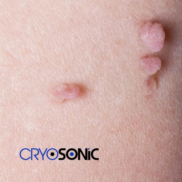 Are you looking for fast effect skin tag removal Tavistock? Book in NOW! Tavistock