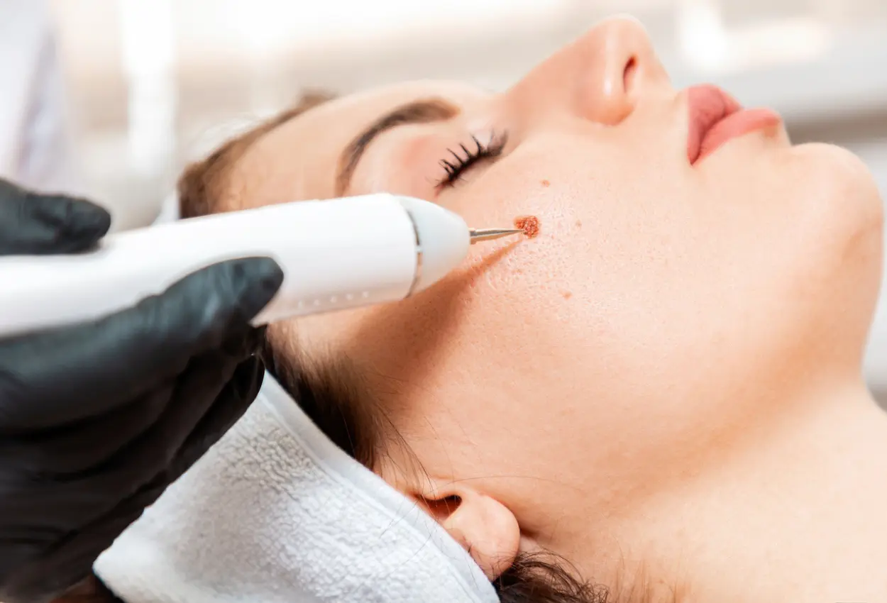 Frequently Asked Questions About Multiple Cryotherapy Treatments Tavistock
