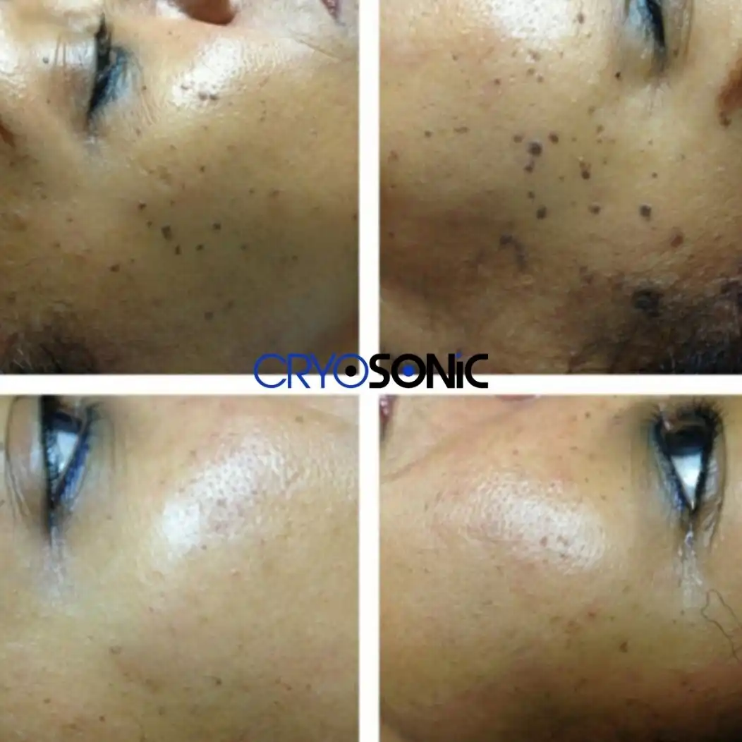 Why Skin Shows Pigmentation After Treatment Tavistock