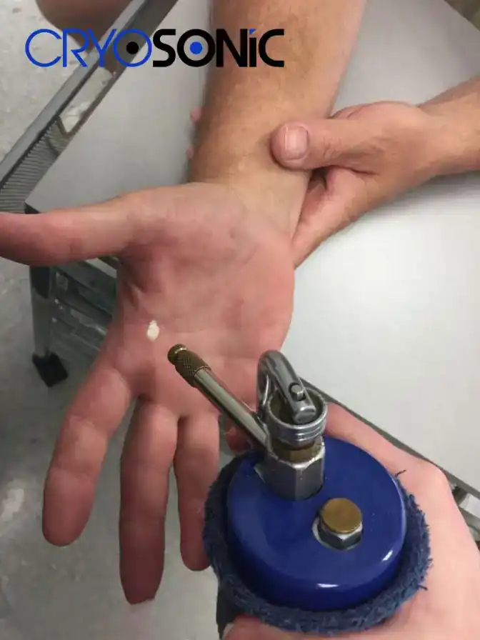 Temperature Differences: OTC vs Medical-Grade Cryotherapy Tavistock